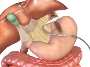 gastric-band