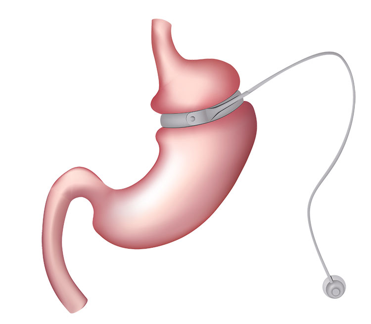 Gastric Band