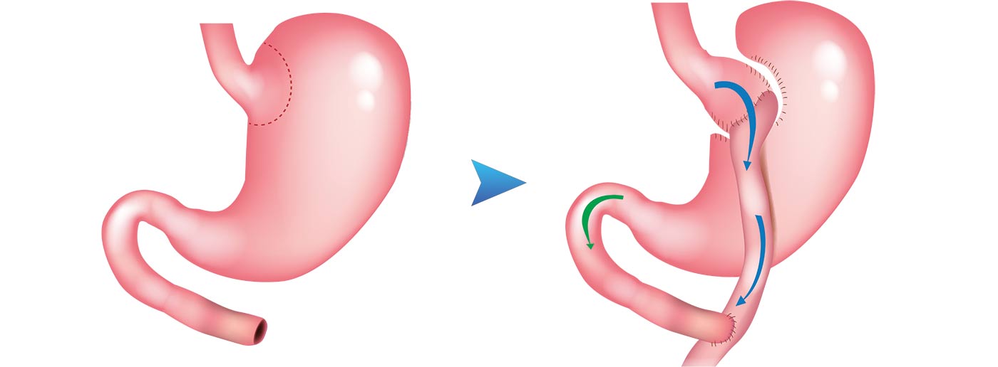 Gastric Bypass Before and After