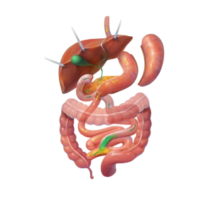 Duodenal Switch Graphic
